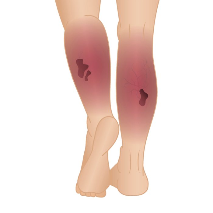 Hesi case study deep vein thrombosis