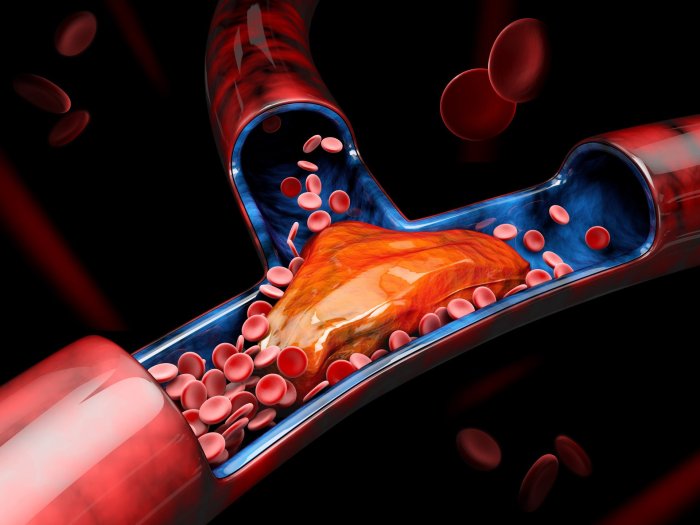 Hesi case study deep vein thrombosis