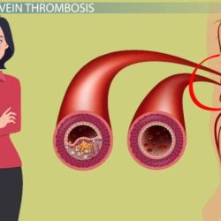 Hesi case study deep vein thrombosis