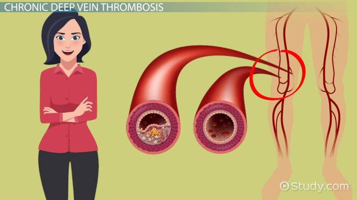 Hesi case study deep vein thrombosis